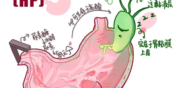 【必看】幽門(mén)螺桿菌真相揭示，別再忽視你的胃痛了！